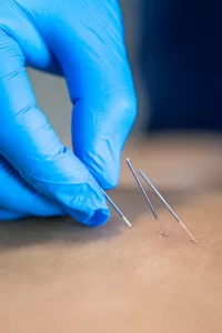 Physiotherapist inserting acupuncture needle at Harmonizing Care