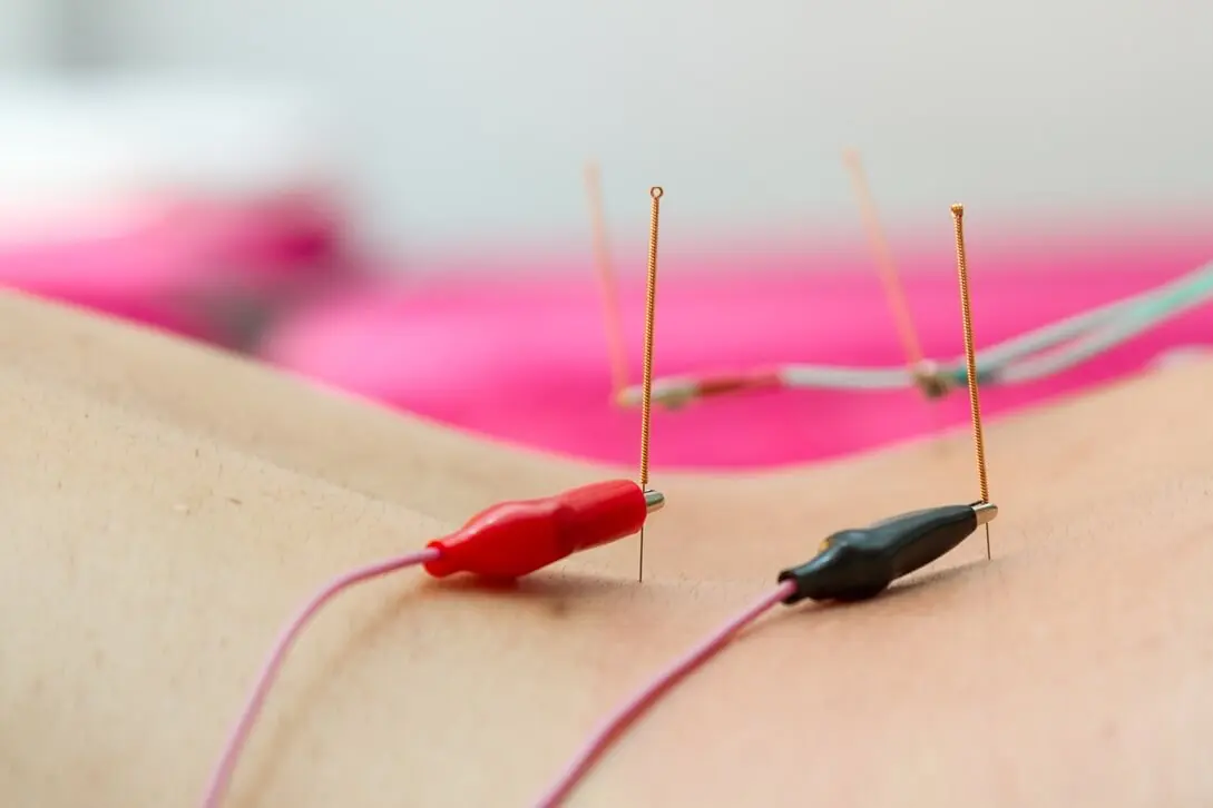 Electro-acupuncture at harmonizing healthcare